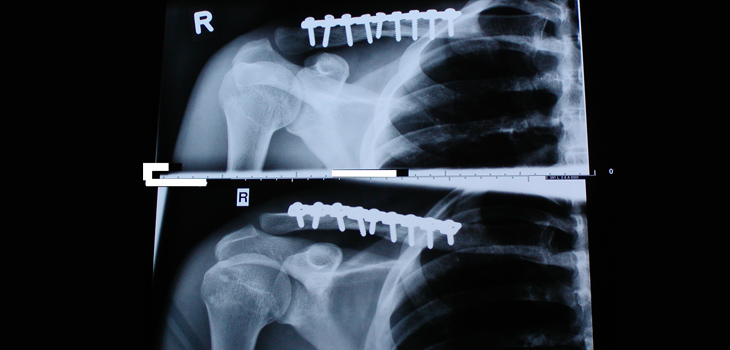 Implant Market Forecast to Hit $116 Billion
