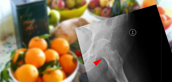 22% Lower Risk of Hip Fracture With Mediterranean Diet