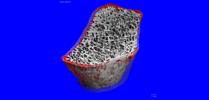Obesity and Permanent Bone Loss; Education Improves TKR for Patients; Avoid Tunnel Convergence in Knee Surgery