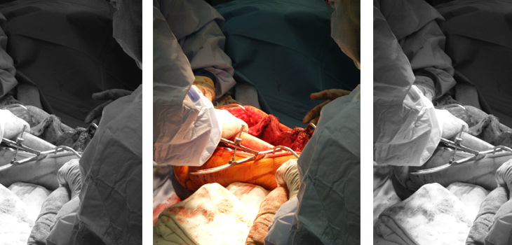 Osteochondral Allograft: More Efficient Donor-Host Matching?