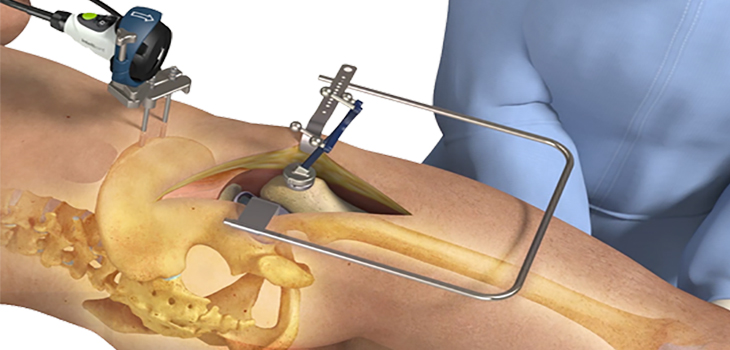 $11MM to Intellijoint Surgical!