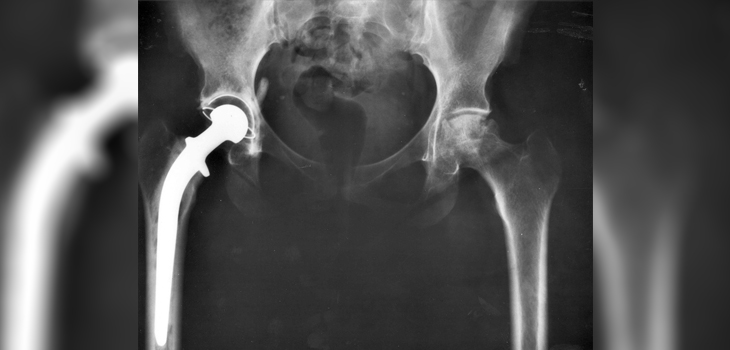 Study Examines Move to Ceramic Heads in Primary THA