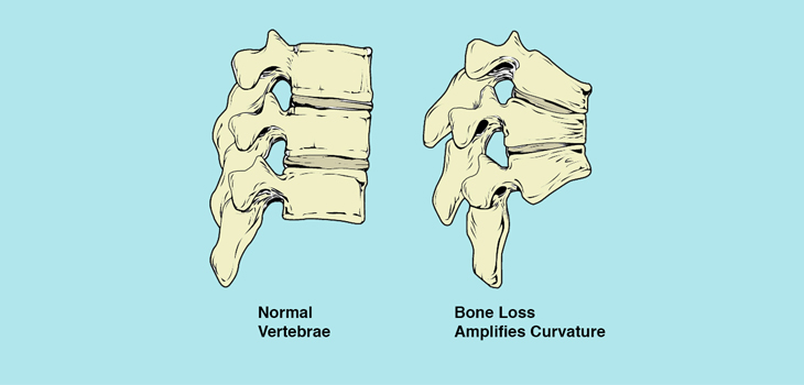 Cancer and Radiation-Induced Bone Loss: Protecting Cells
