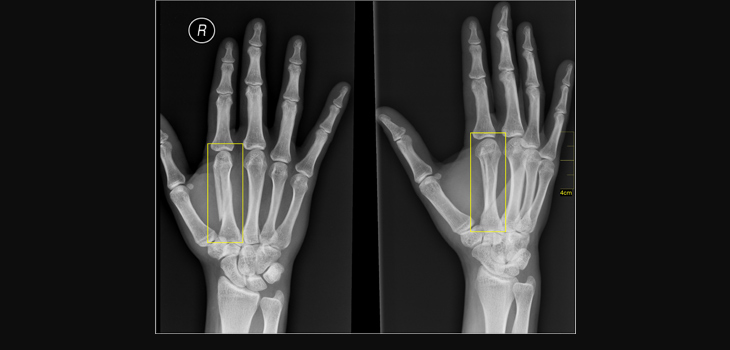 Bioresorbable Implant May Improve Fracture Healing