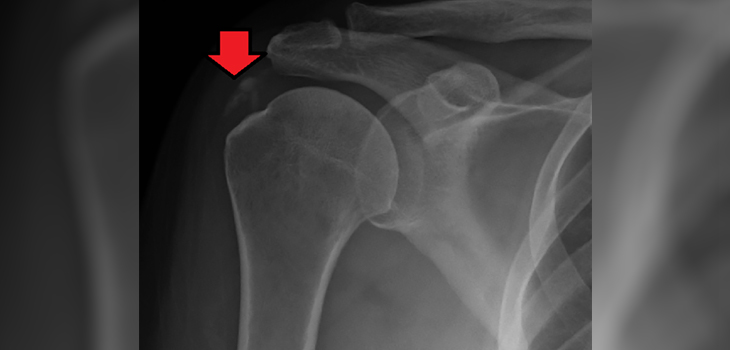 Tendon Overuse Injuries and Surrounding Tissues