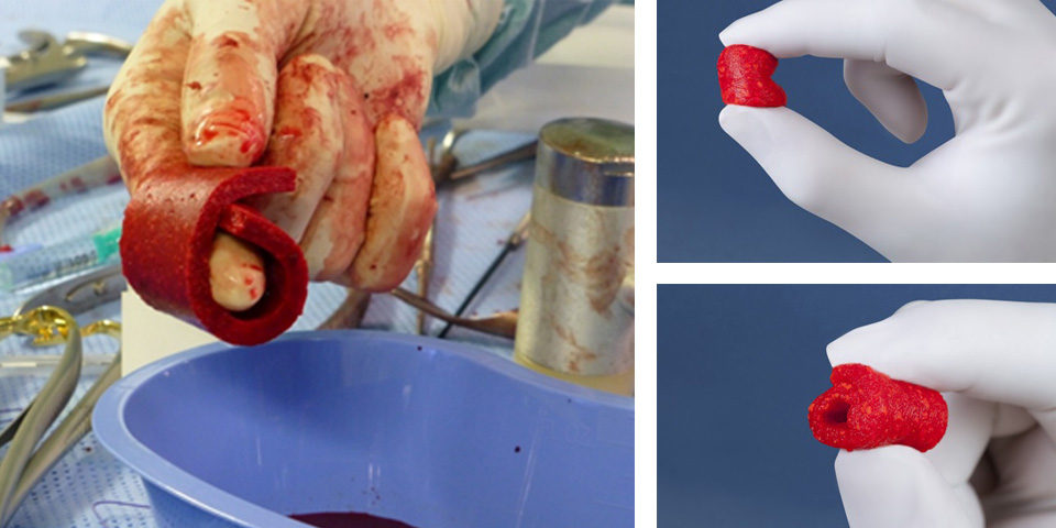 FDA Approves Novel Bone Foam