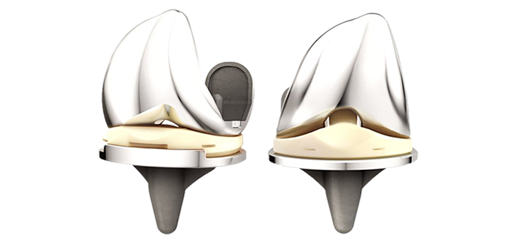 Australian Joint Registry: Positive Early Results For ATTUNE Knee