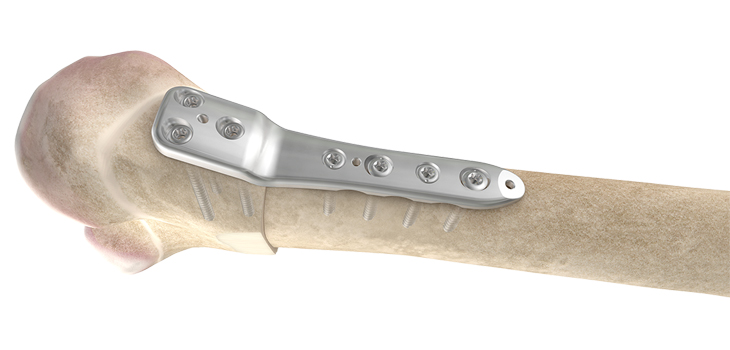 OrthoPediatrics Launches Distal Femoral Osteotomy System