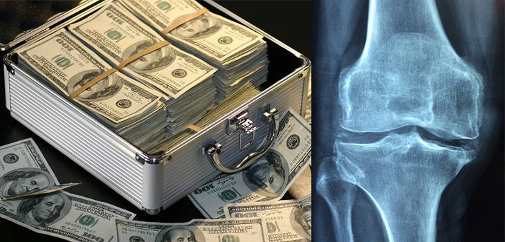 USC: $2.5 Million for Translational Osteoarthritis Research
