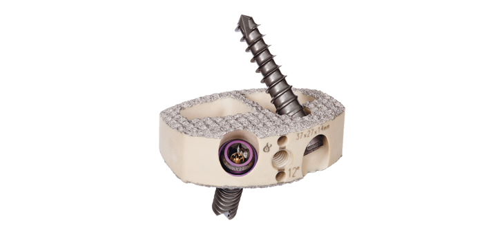 Spinal Elements: Positive Results for Magnum+ ALIF Device