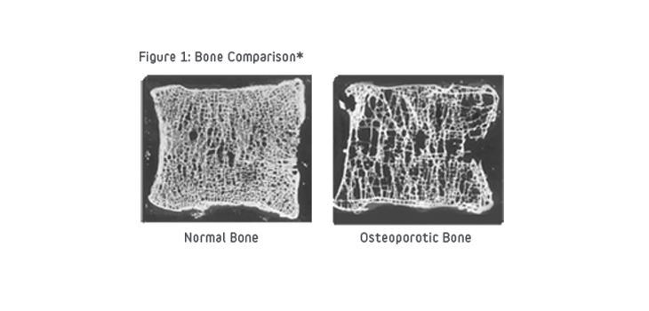 Osteoporosis: Expanded Criteria Protects More Patients