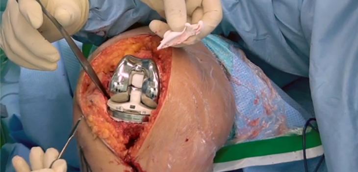 Total Knee Replacement Surgery – In Hospital or Outpatient?