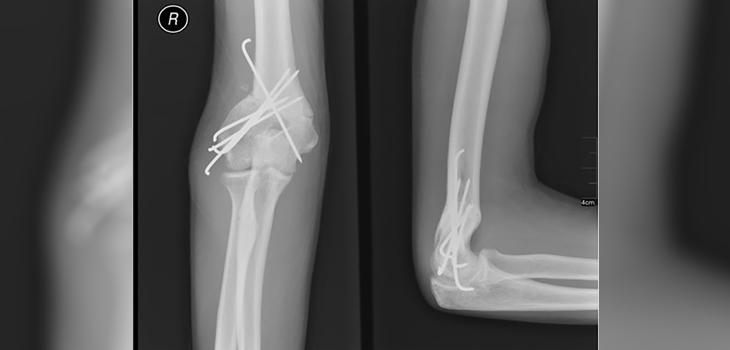 Cannulated Lag Screws Superior to Pins
