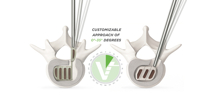 VTI: Successful Lumbar Fusion in Mexico With InterFuse