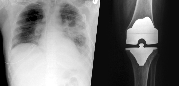 Pneumonia After TJA: NYU & Bundled Payments; Direct Anterior and Revisions