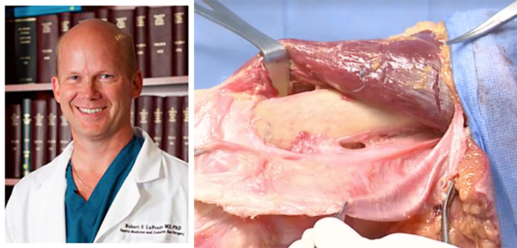 Robert LaPrade, M.D. Performs Knee Dissection on Facebook!