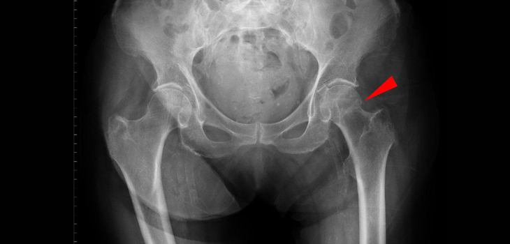 Serum Albumin Predicts Death in Hip Surgery