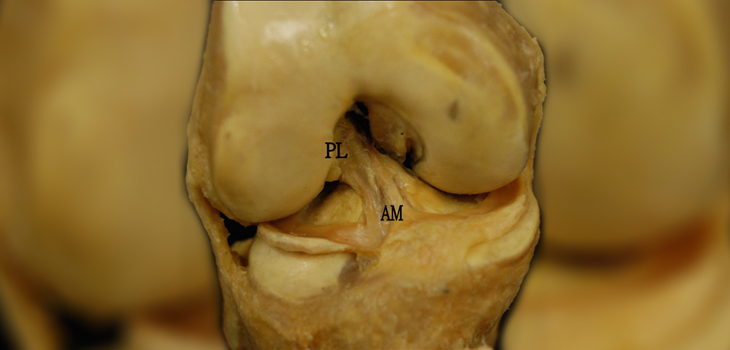 HSS Tackles Best Approach for ACL-Deficient Knees
