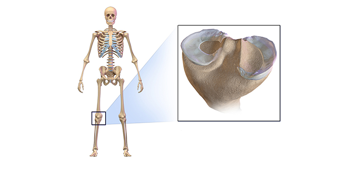 First Meniscus Replacements in Texas With NUsurface Implant