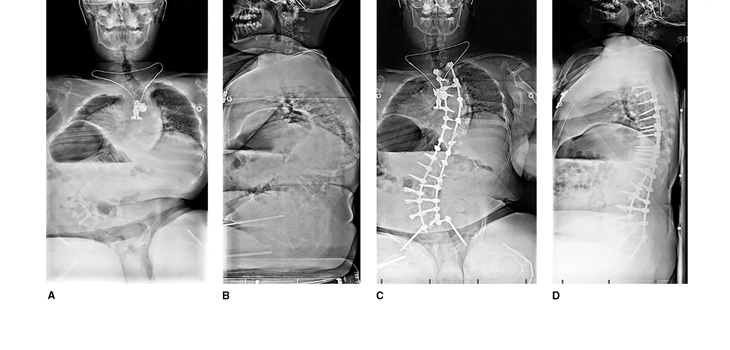 Osteogenesis Imperfecta: What’s Happening in the Spine?