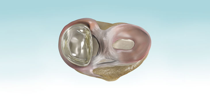 Two Trials Test Poly Urethane Meniscus
