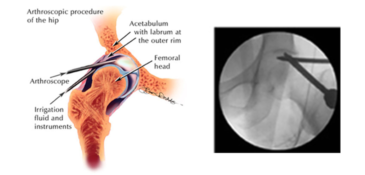New Study: Too Much Hip Arthroscopy Variability