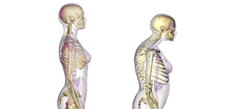 Goal-Directed Treatment for Osteoporosis: A Progress Report