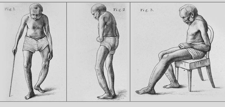 Paget’s: Fracture Risk INCREASED With Intensive Treatment