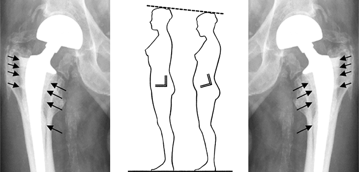 THA and Variation in Functional Pelvic Tilt