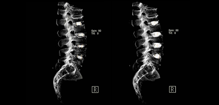 A Fresh Look at Bone Graft