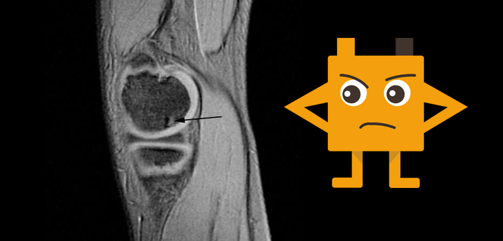 TKA Patients <55: Who Will Be Dissatisfied?