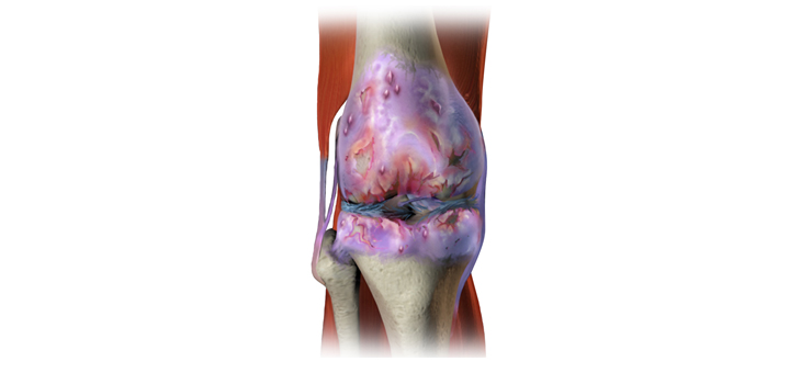 Knee Cartilage Defects: Biologic Resurfacing Versus Focal Metallic Implants