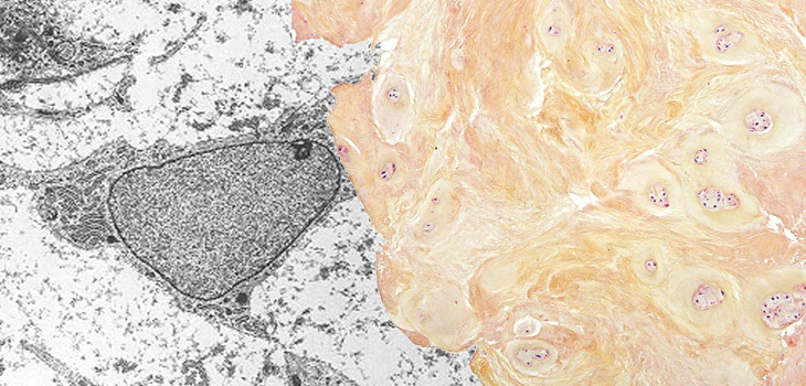 Cell Therapy for DDD; Joint Replacement Risk Unpredictable?; Open Fracture Injection Insight