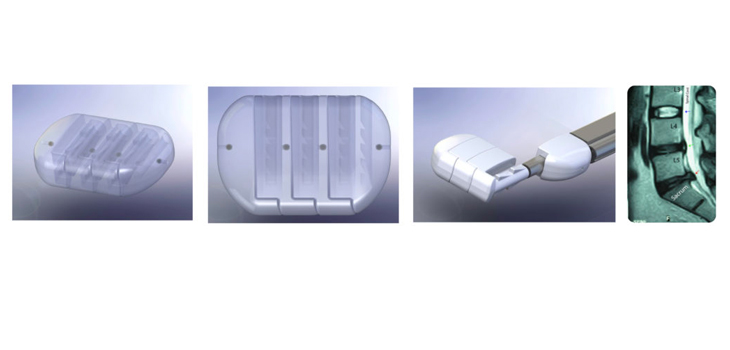 VTI: A Patent for InterCushion