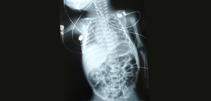 New Recommendations on Reducing Radiation Exposure in Children