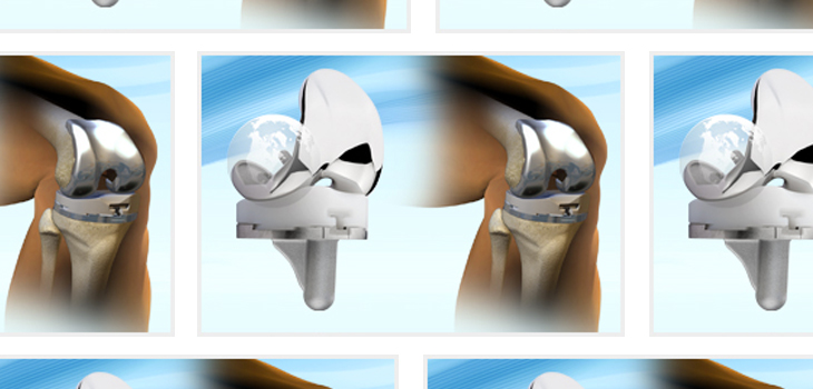 MicroPort Launches EVOLUTION Revision Tibial System, BioFoam Tibia