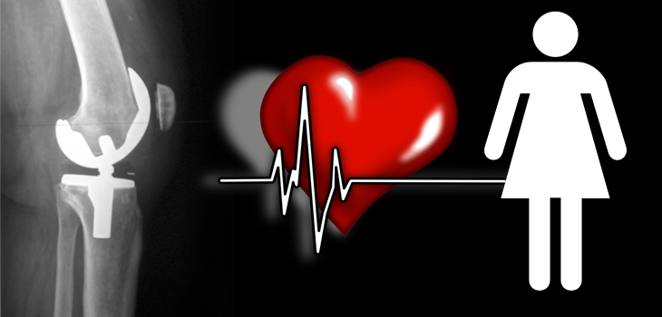 Women Less Likely to Experience Heart Attack, Stroke, After TJA