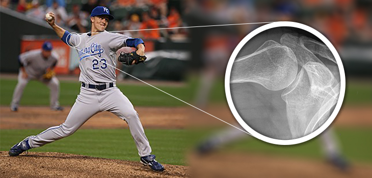 Baseball: Two-out Drill Reduces Risk of Shoulder Injury