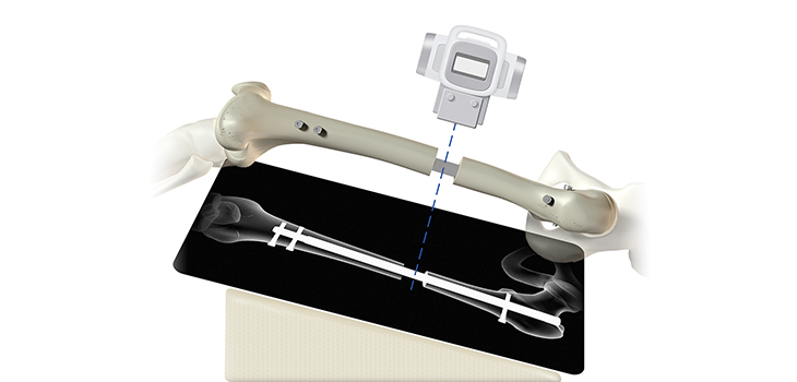 Bone Healing During IM Lengthening: Clarity!