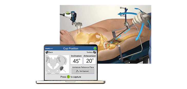 intellijoint HIP Anterior Receives FDA Clearance