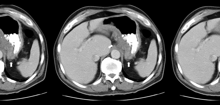The Bacterial Link Between Crohn’s Disease and Arthritis