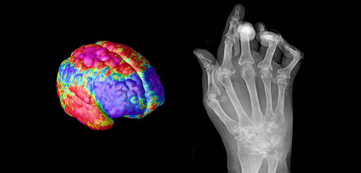 Inverse Relationship Between Schizophrenia and RA?