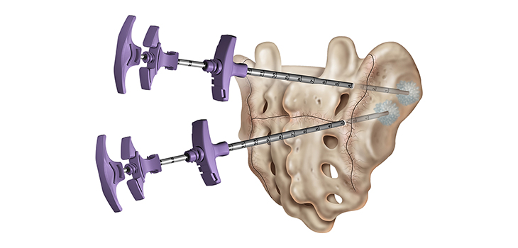 Medtronic Bone Cement Cleared for Sacroplasty