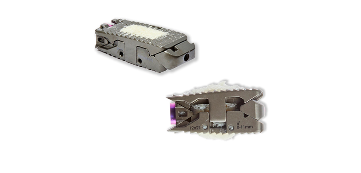 Spineology Expandable Interbody Fusion System Cleared for Allografts