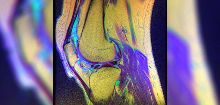 OCA Transplantation After Failed Knee Microfracture