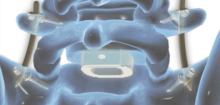 PEEK Rods to Benefit From FDA Reclassification of Spinal Systems?