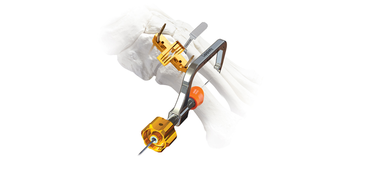Treace Medical Receives Lapiplasty® Patent