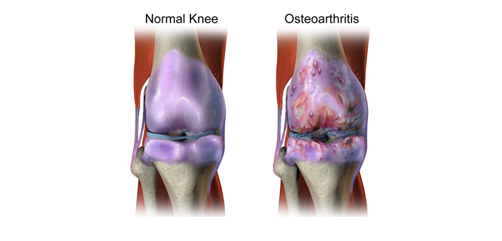 New Study: Better TKA Patient Selection Needed