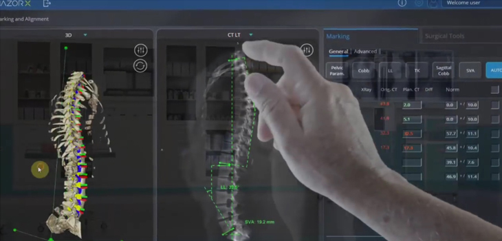 Mazor’s X Align Software Cleared by FDA