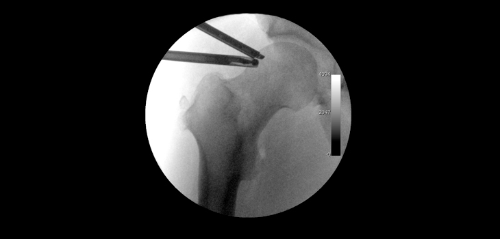 Fluid Extravasation in Hip Arthroscopy: What to Look For